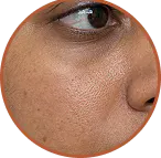 Mixed SKin